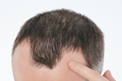 Could nutrient deficiencies lead to hair loss?